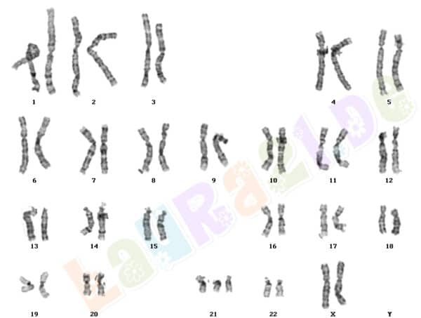 Trisomie 13 : comprendre le pronostic, soins et ressources pour les familles