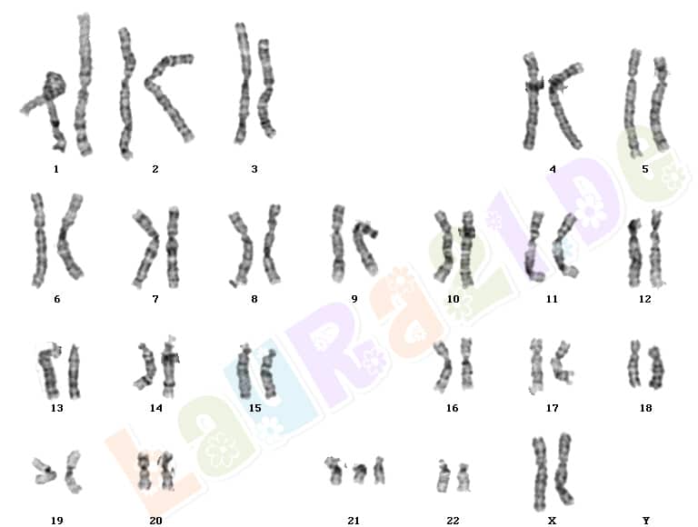 trisomie 13 esp&eacute;rance de vie
